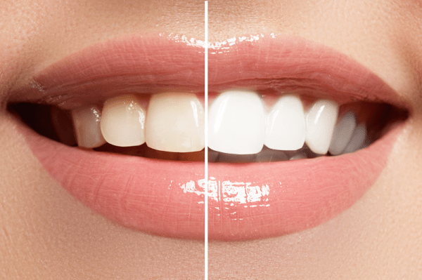 Zahnfarbe vor und nach dem Bleaching